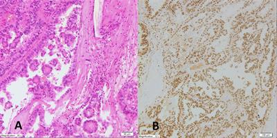 Case Report: TFE3 Positive Xp11.2 Translocation Renal Cell Carcinoma (TRCC) – A Case Study and Review of the Literature